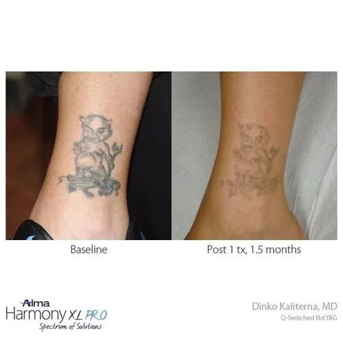 Laser Tattoo Removal